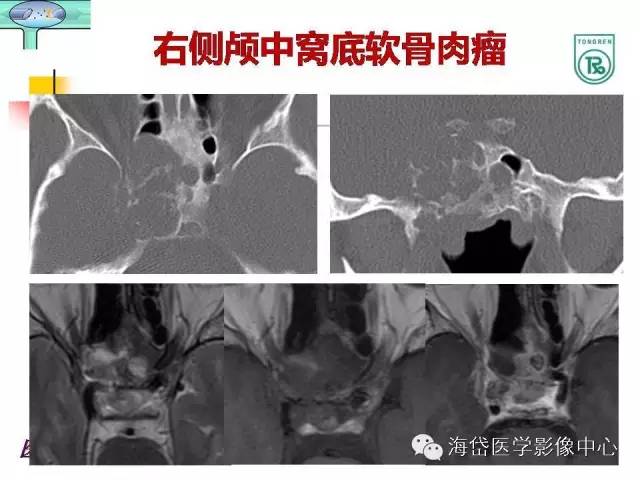 【PPT】颅底骨质破坏性病变的影像学诊断思路