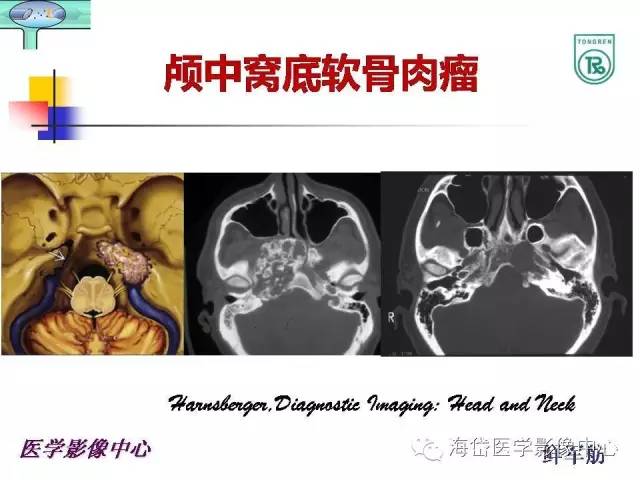 【PPT】颅底骨质破坏性病变的影像学诊断思路