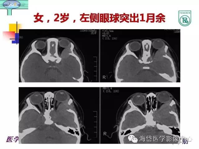 【PPT】颅底骨质破坏性病变的影像学诊断思路