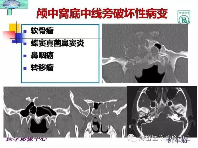 【PPT】颅底骨质破坏性病变的影像学诊断思路