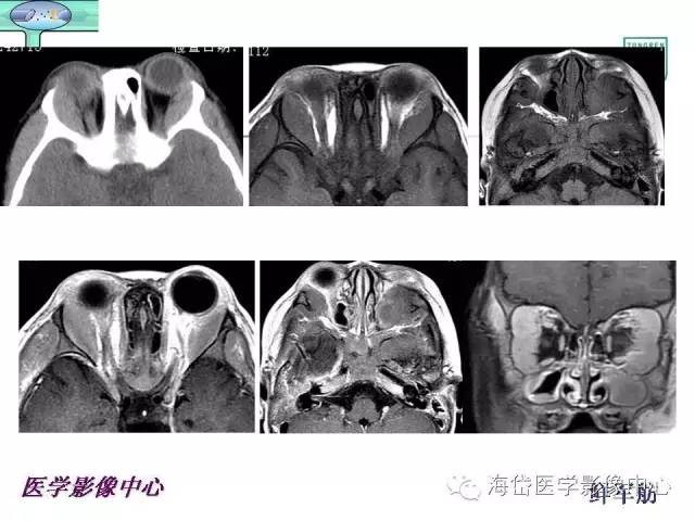 【PPT】颅底骨质破坏性病变的影像学诊断思路
