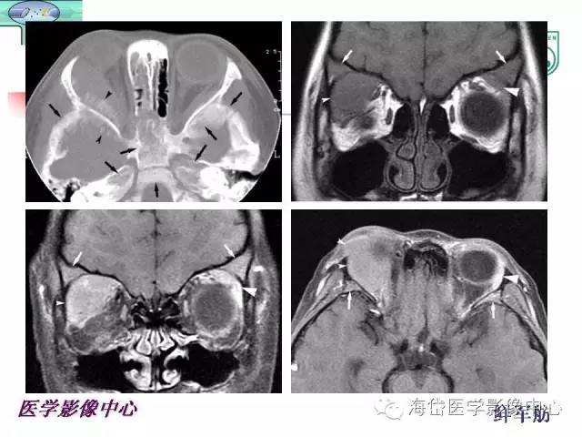 【PPT】颅底骨质破坏性病变的影像学诊断思路