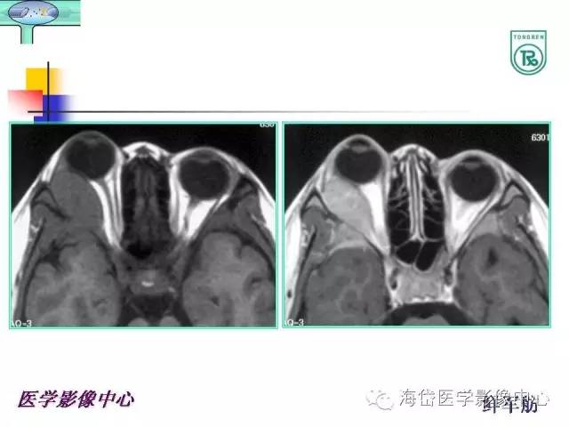 【PPT】颅底骨质破坏性病变的影像学诊断思路