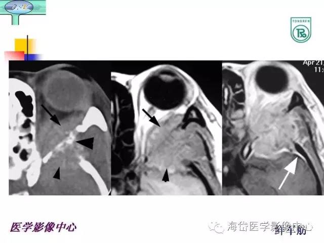 【PPT】颅底骨质破坏性病变的影像学诊断思路