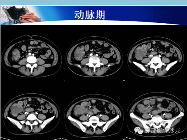 【病例】回盲部粘液腺癌1例CT影像表现 【病例】回盲部粘液腺癌1例CT影像表现