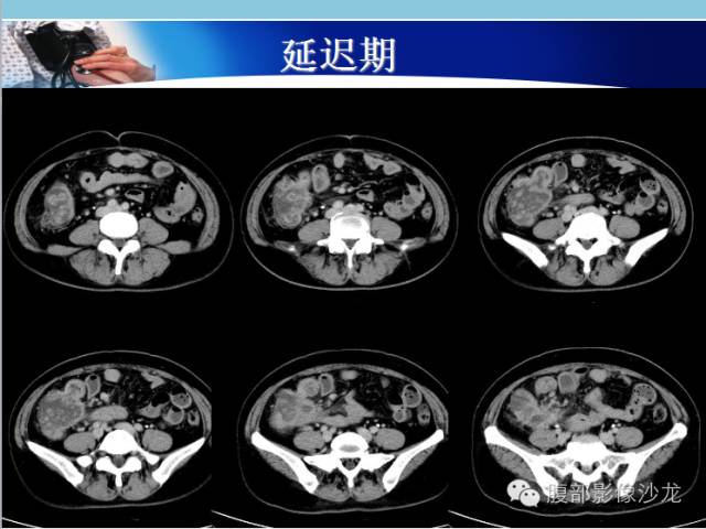 【病例】回盲部粘液腺癌1例CT影像表现 【病例】回盲部粘液腺癌1例CT影像表现
