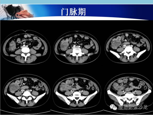 【病例】回盲部粘液腺癌1例CT影像表现 【病例】回盲部粘液腺癌1例CT影像表现