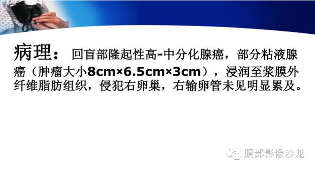 【病例】回盲部粘液腺癌1例CT影像表现 【病例】回盲部粘液腺癌1例CT影像表现