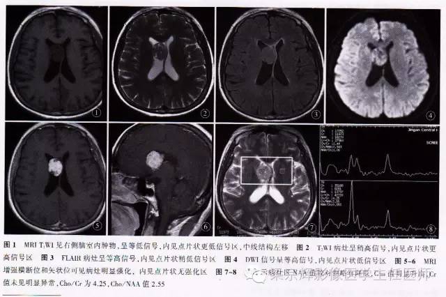侧脑室内占位的诊断分析