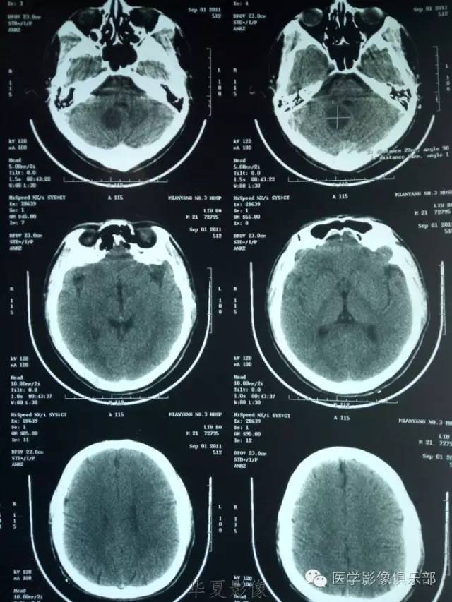 【病例】毛细胞型星形细胞瘤1例MR病例解析