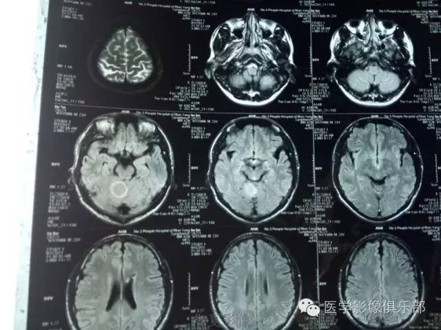 【病例】毛细胞型星形细胞瘤1例MR病例解析 【病例】毛细胞型星形细胞瘤1例MR病例解析
