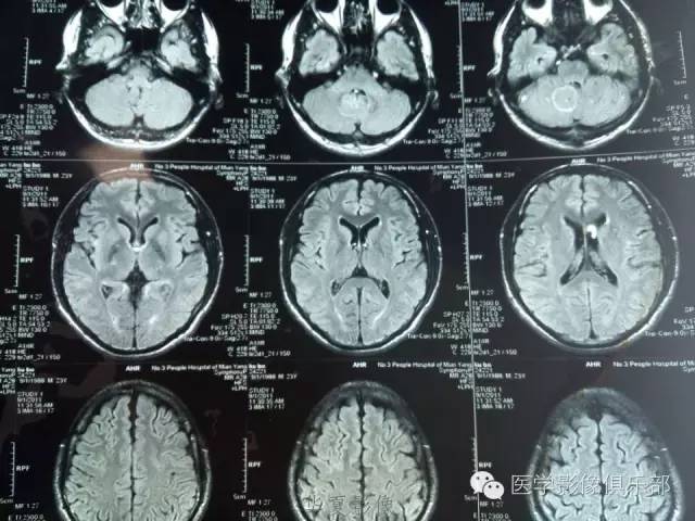 【病例】毛细胞型星形细胞瘤1例MR病例解析 【病例】毛细胞型星形细胞瘤1例MR病例解析