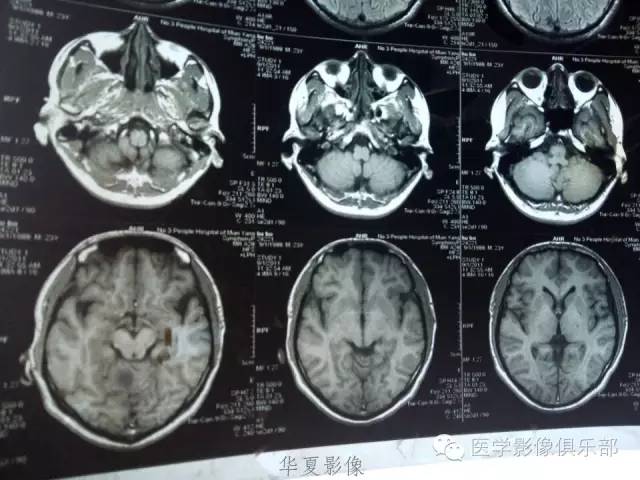 【病例】毛细胞型星形细胞瘤1例MR病例解析 【病例】毛细胞型星形细胞瘤1例MR病例解析