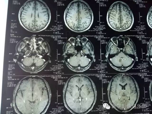 【病例】毛细胞型星形细胞瘤1例MR病例解析 【病例】毛细胞型星形细胞瘤1例MR病例解析