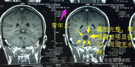 【病例】毛细胞型星形细胞瘤1例MR病例解析 【病例】毛细胞型星形细胞瘤1例MR病例解析