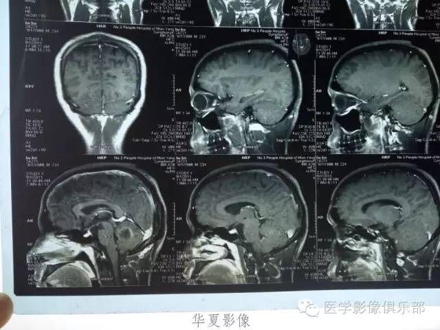 【病例】毛细胞型星形细胞瘤1例MR病例解析 【病例】毛细胞型星形细胞瘤1例MR病例解析
