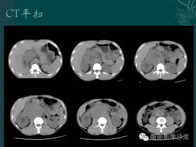 【病例】腹膜后精原细胞瘤1例CT影像表现