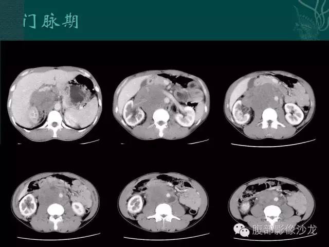 【病例】腹膜后精原细胞瘤1例CT影像表现