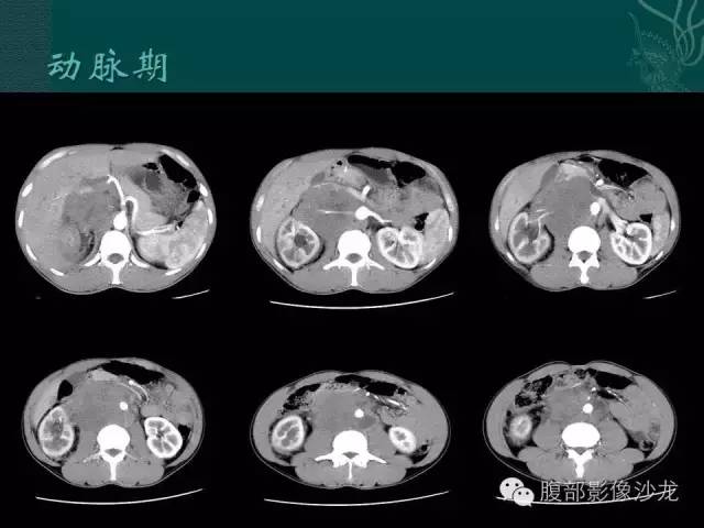【病例】腹膜后精原细胞瘤1例CT影像表现