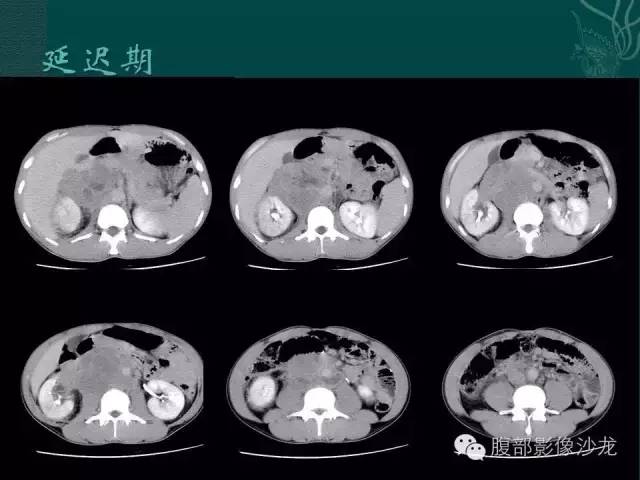 【病例】腹膜后精原细胞瘤1例CT影像表现