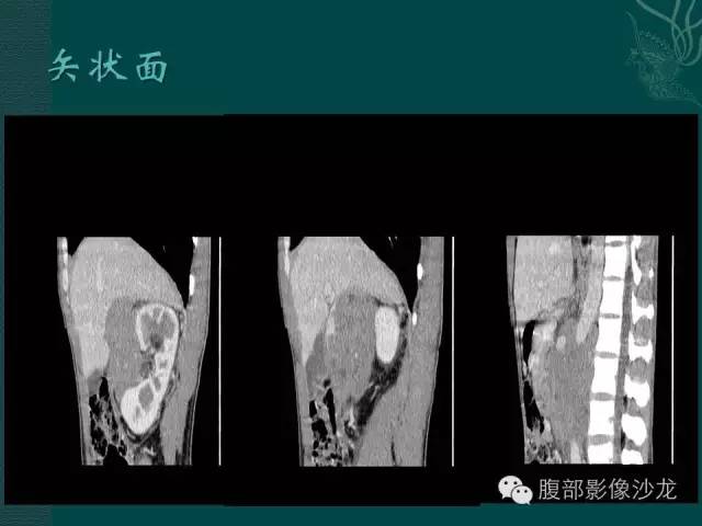 【病例】腹膜后精原细胞瘤1例CT影像表现