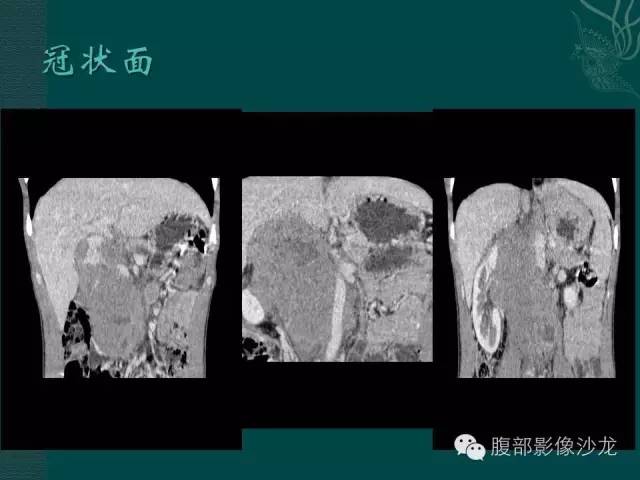 【病例】腹膜后精原细胞瘤1例CT影像表现