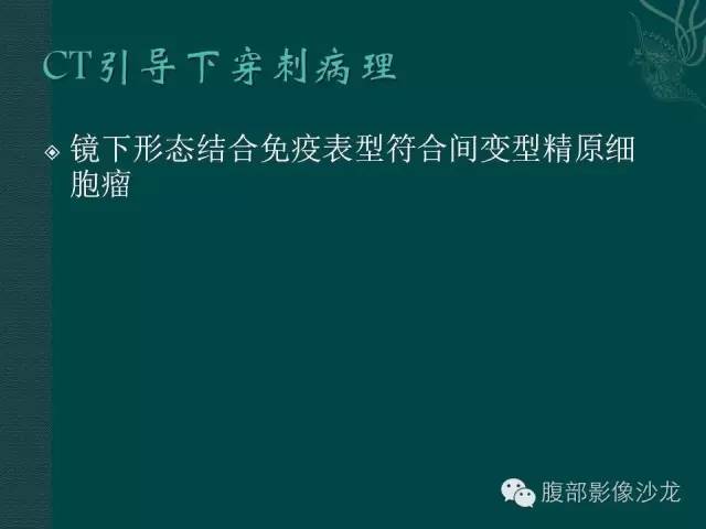 【病例】腹膜后精原细胞瘤1例CT影像表现