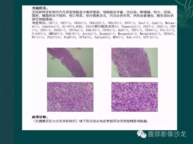 【病例】腹膜后精原细胞瘤1例CT影像表现
