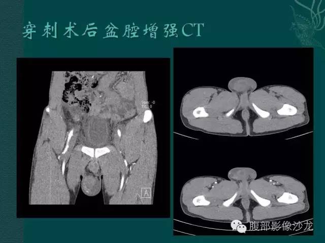 【病例】腹膜后精原细胞瘤1例CT影像表现