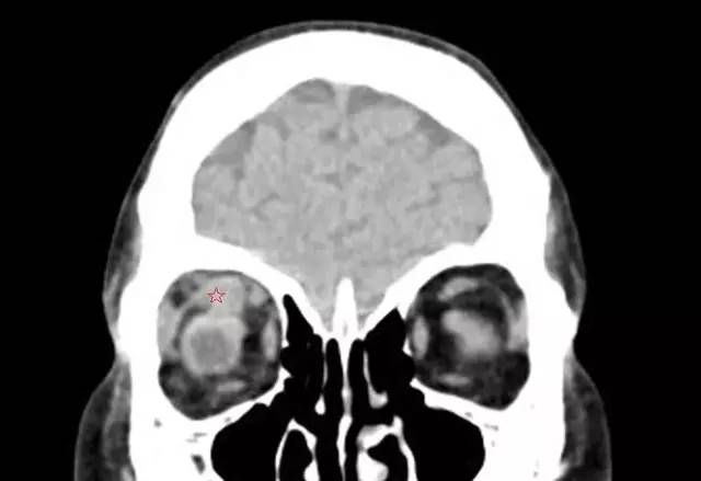 【病例】累及上直肌的眼内转移性病变1例CT影像表现 【病例】累及上直肌的眼内转移性病变1例CT影像表现
