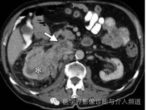 下腔静脉疾病影像诊断 下腔静脉疾病影像诊断