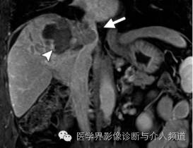 下腔静脉疾病影像诊断 下腔静脉疾病影像诊断