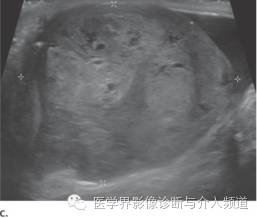 下腔静脉疾病影像诊断 下腔静脉疾病影像诊断