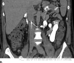 下腔静脉疾病影像诊断 下腔静脉疾病影像诊断