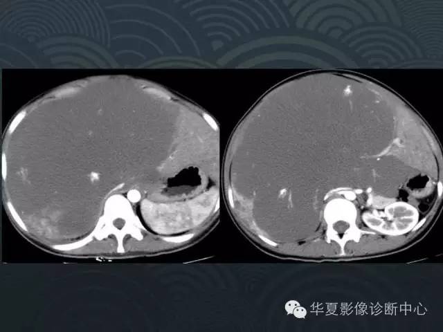 【病例】肝巨大海绵状血管瘤1例CT影像表现