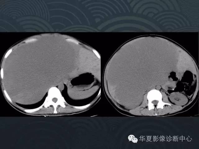 【病例】肝巨大海绵状血管瘤1例CT影像表现
