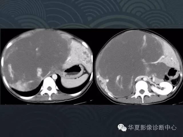 【病例】肝巨大海绵状血管瘤1例CT影像表现