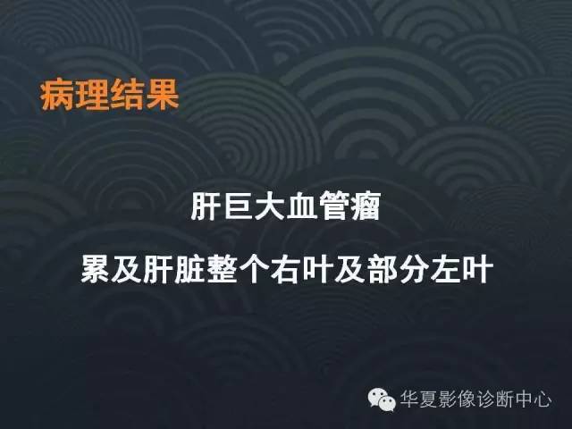 【病例】肝巨大海绵状血管瘤1例CT影像表现
