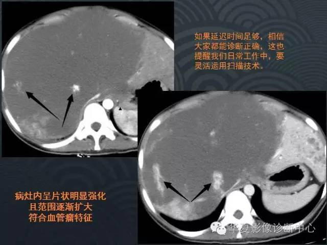 【病例】肝巨大海绵状血管瘤1例CT影像表现