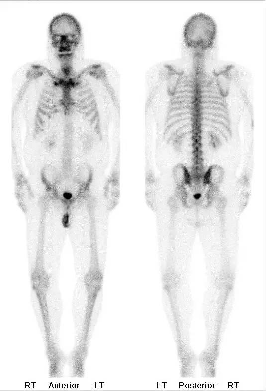 【病例】脆弱性骨硬化1例MR影像表现 【病例】脆弱性骨硬化1例MR影像表现