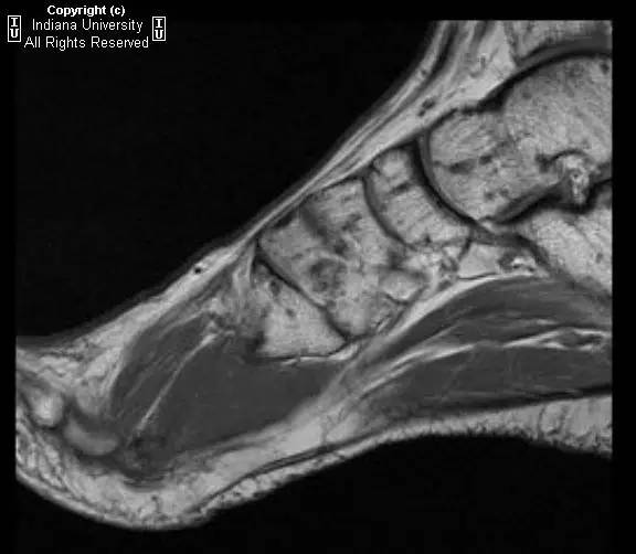 【病例】脆弱性骨硬化1例MR影像表现 【病例】脆弱性骨硬化1例MR影像表现