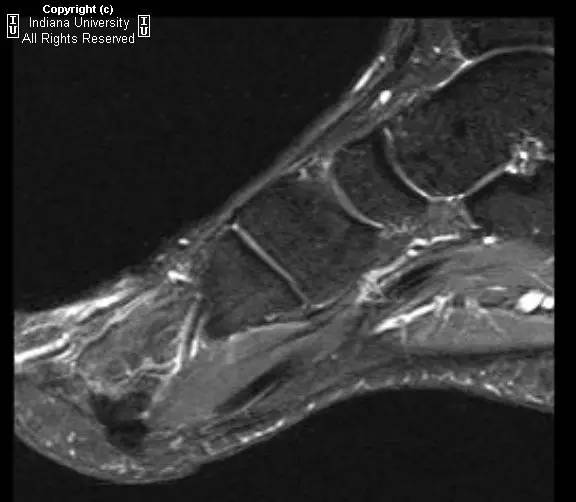 【病例】脆弱性骨硬化1例MR影像表现 【病例】脆弱性骨硬化1例MR影像表现