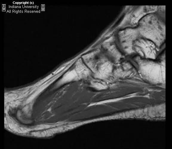 【病例】脆弱性骨硬化1例MR影像表现 【病例】脆弱性骨硬化1例MR影像表现