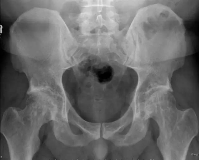 【病例】脆弱性骨硬化1例MR影像表现 【病例】脆弱性骨硬化1例MR影像表现