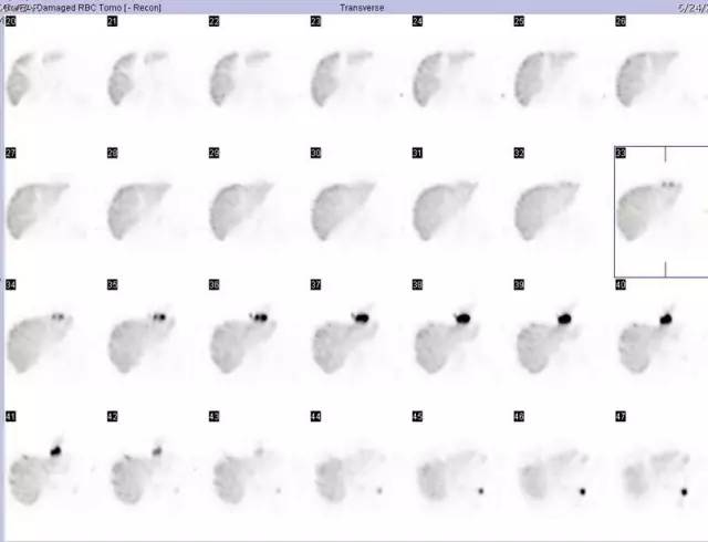 【病例】脾组织种植1例CT影像表现 【病例】脾组织种植1例CT影像表现