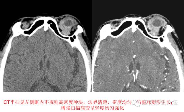 眼眶内常见肿瘤性病变的影像诊断
