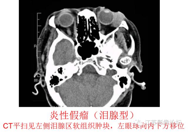 眼眶内常见肿瘤性病变的影像诊断 眼眶内常见肿瘤性病变的影像诊断