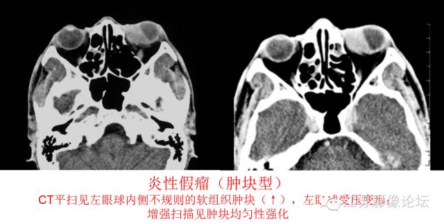 眼眶内常见肿瘤性病变的影像诊断 眼眶内常见肿瘤性病变的影像诊断