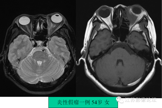 眼眶内常见肿瘤性病变的影像诊断 眼眶内常见肿瘤性病变的影像诊断