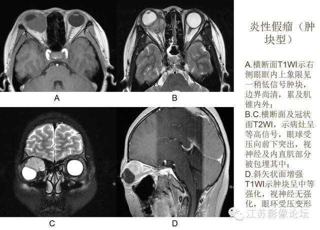 眼眶内常见肿瘤性病变的影像诊断 眼眶内常见肿瘤性病变的影像诊断